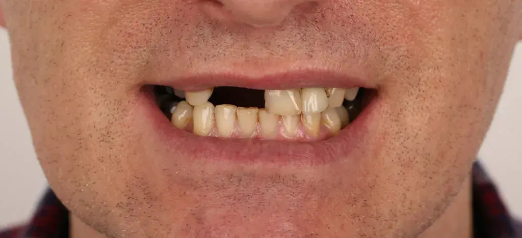 Zirconia Crown Before and After - Inci Dis Dental Clinic Turkey