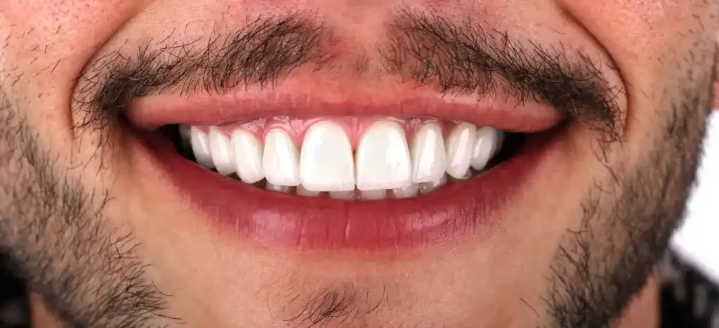 Laminate Veneers Before and After - Inci Dis Dental Clinic Turkey