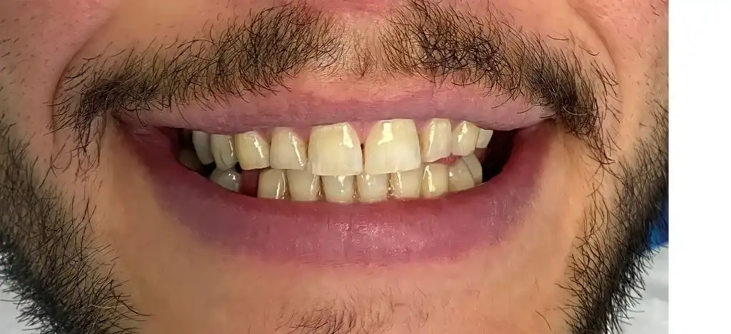 Laminate Veneers Before and After - Inci Dis Dental Clinic Turkey