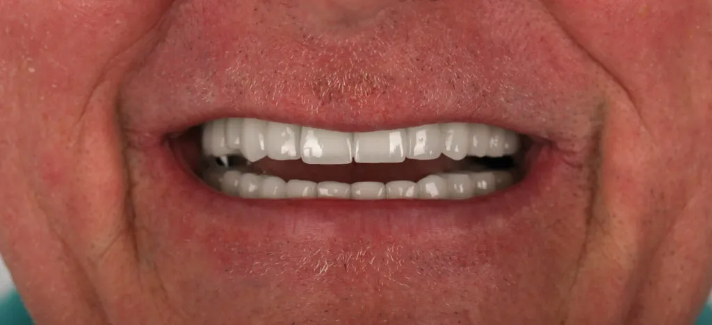 Dental İmplants Before and After - Inci Dis Dental Clinic Istanbul Turkey