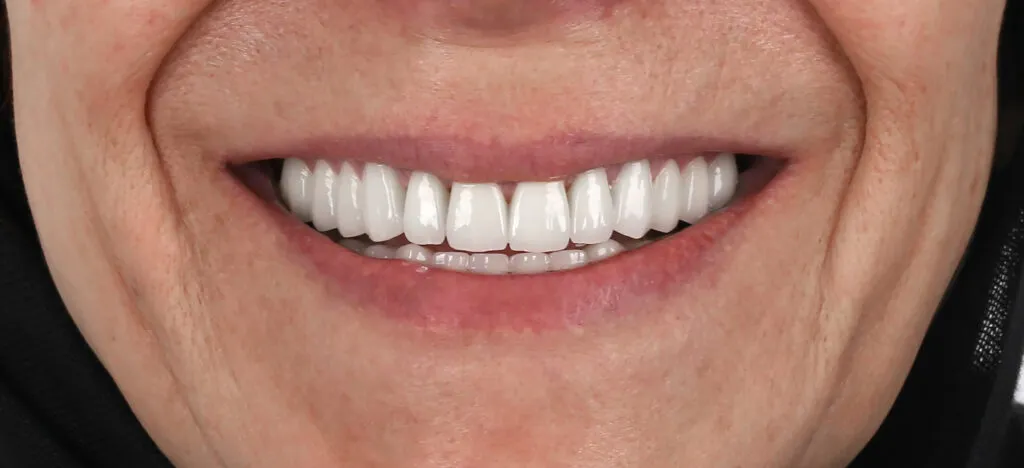 Zirconia Crown Before and After - Inci Dis Dental Clinic Istanbul Turkey - 3