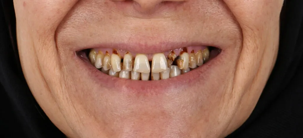 Zirconia Crown Before and After - Inci Dis Dental Clinic Istanbul Turkey - 3