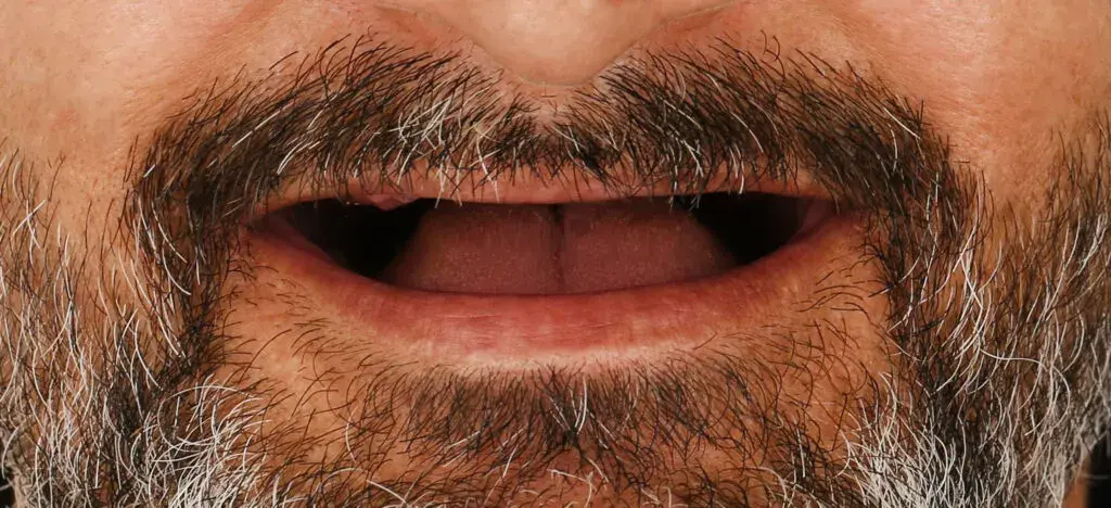 Dental İmplants Before and After - Inci Dis Dental Clinic Istanbul Turkey - 2
