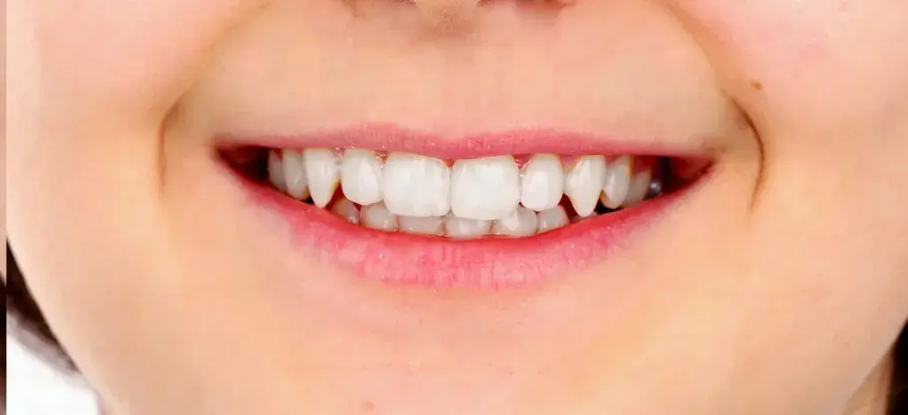 Esthetic Fillings Before and After - Inci Dis Dental Clinic Istanbul Turkey