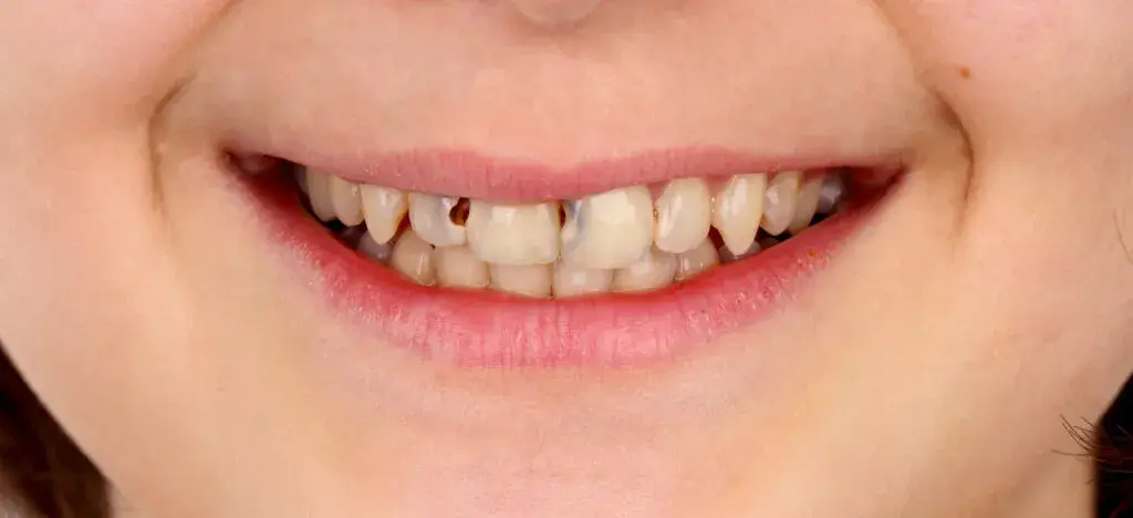 Esthetic Fillings Before and After - Inci Dis Dental Clinic Istanbul Turkey