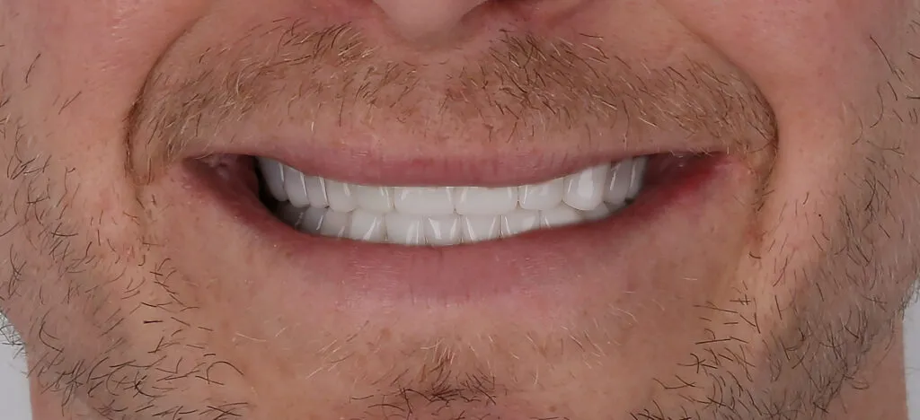 Zirconia Crown & Root Canal Before and After - Inci Dis