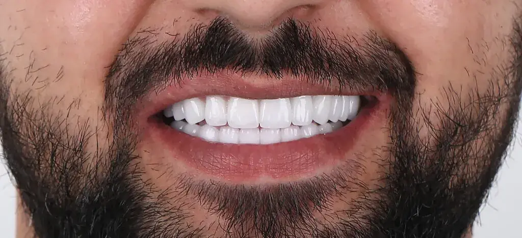 Zirconia Crown & Root Canal Before and After - Inci Dis - 1