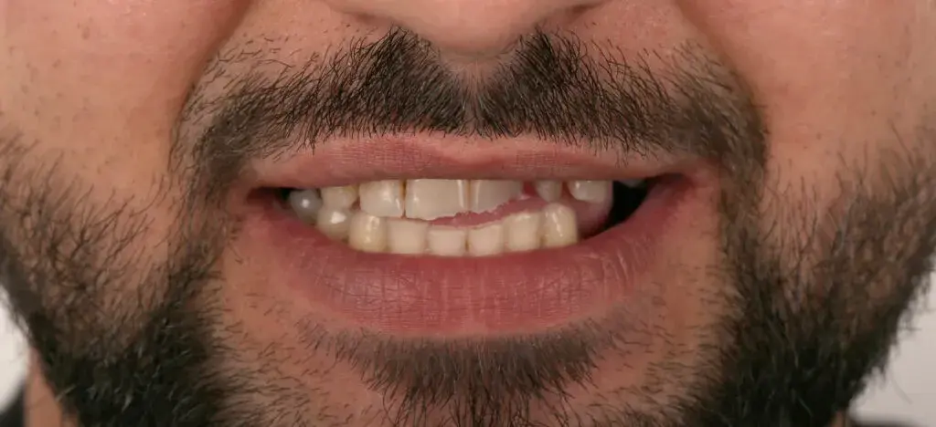 Zirconia Crown & Root Canal Before and After - Inci Dis - 1