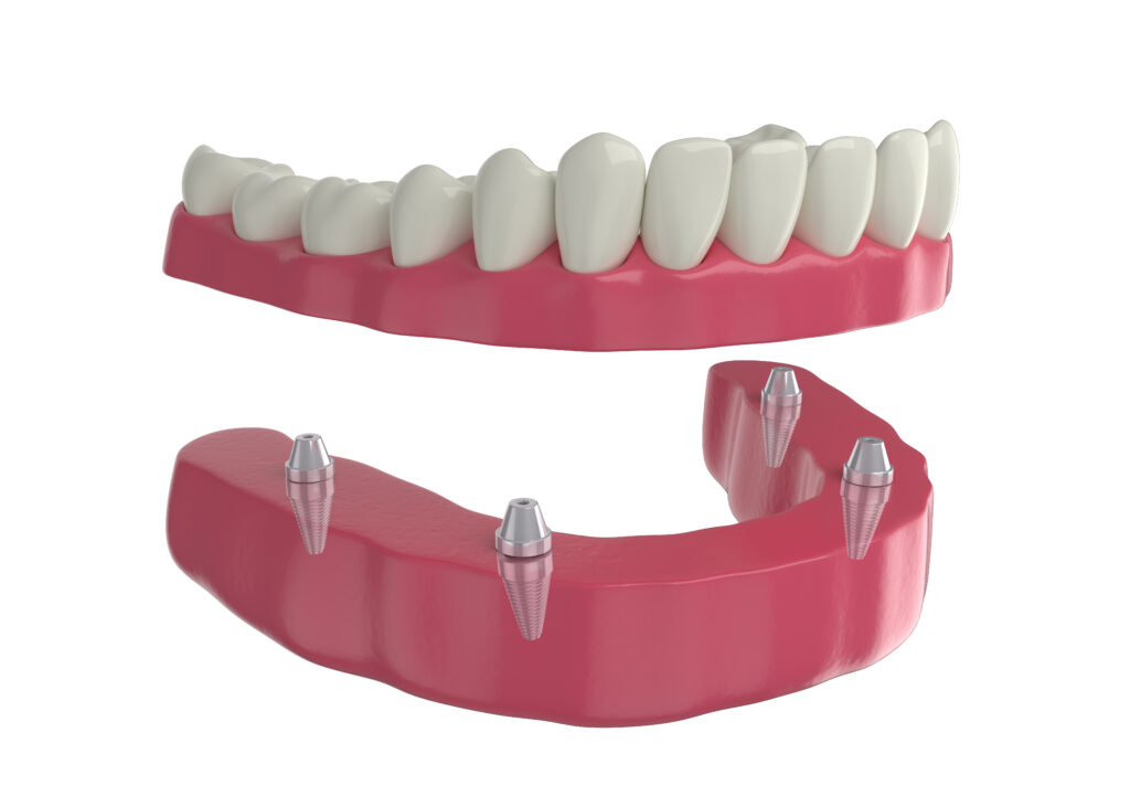 all on 4 dental implants turkey price - inci dis dental clinic turkey