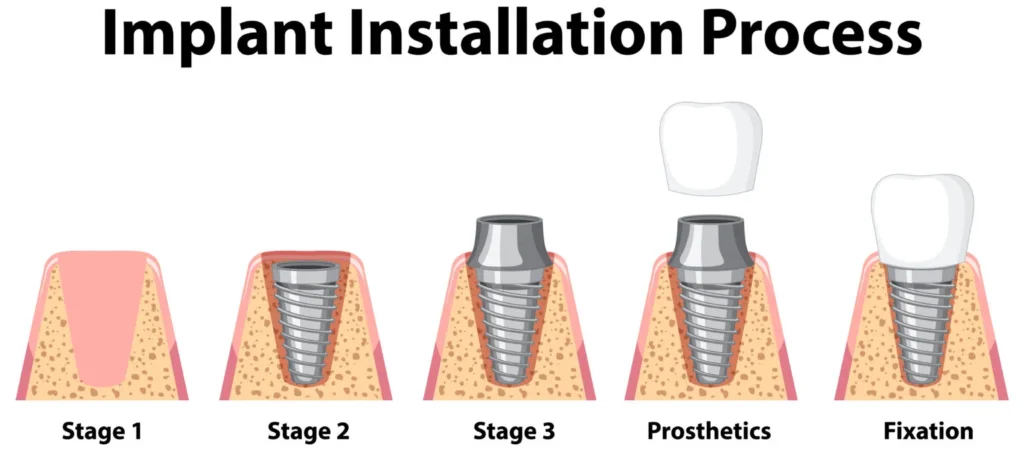 qu'est-ce-qu'un-implant-dentaire-1