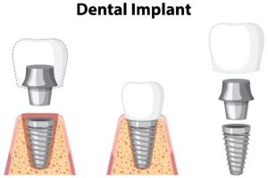 Dental implants Turkey - Inci Dis dental Clinic Turkey