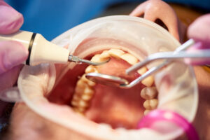 Root Canal Turkey - Inci Dis Dental Clinic Turkey