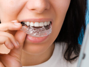 Teeth Straightening