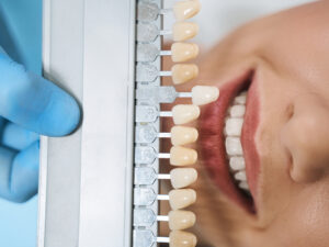 Emax Veneers Istanbul