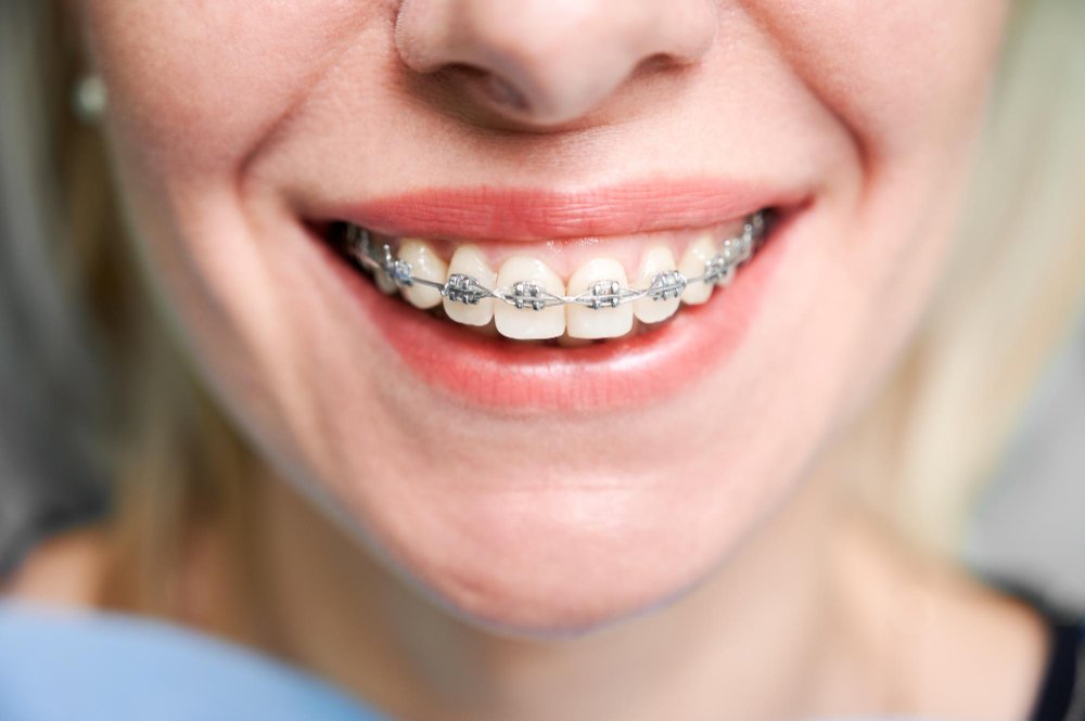 Orthodontic Braces